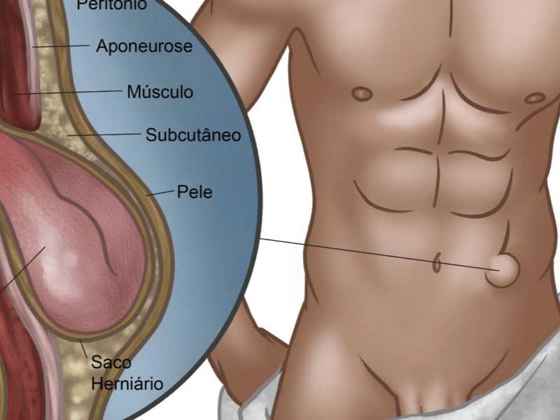 Hérnias da parede abdominal - Clínica Sivieri